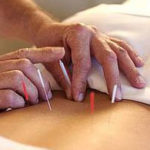 accupuncture1